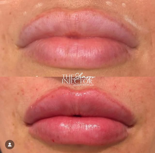 Lip filler injection before and after