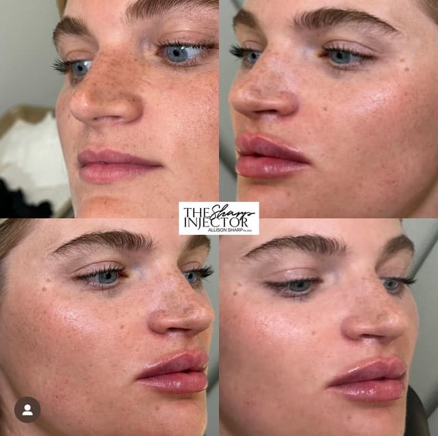 Lip filler injection before and after