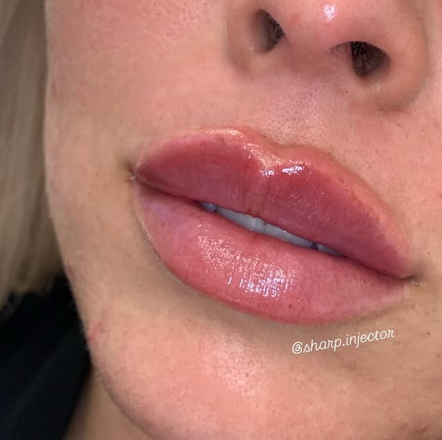 Subtle lip filler enhancement for a natural Huntington Beach aesthetic by Allie Sharp RN.