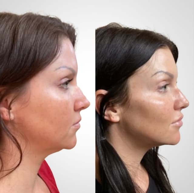 Side profile before and after of jawline and chin filler for facial balancing in Huntington Beach by Allie Sharp, RN.