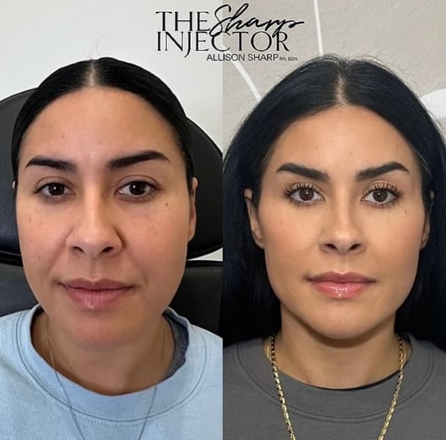 Full facial balancing results using Botox and dermal filler for a youthful, feminine profile in SoCal.
