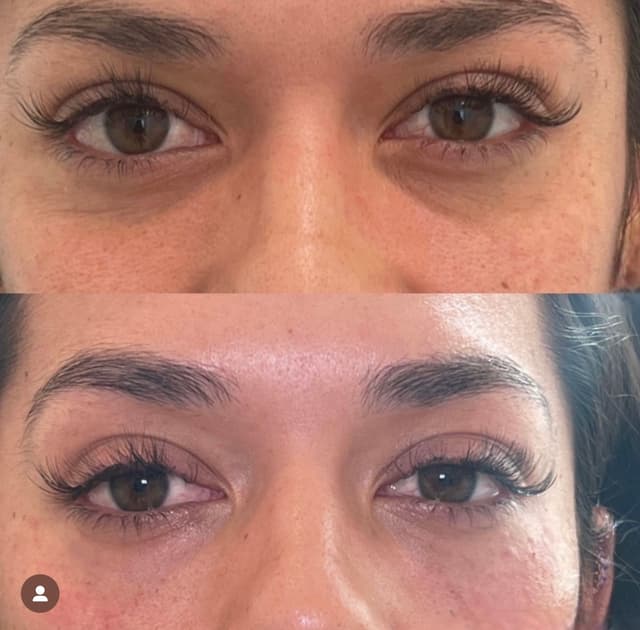 Under eye brightening before and after