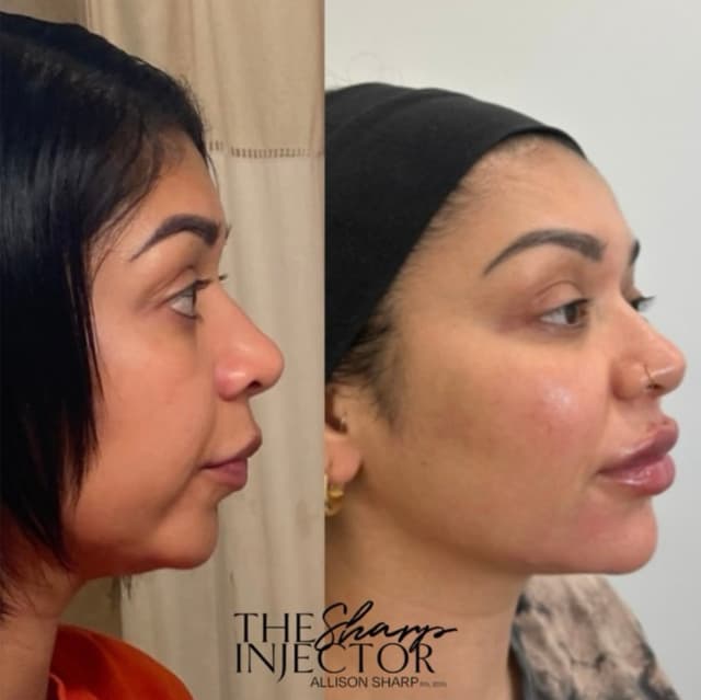 Natural chin filler and jawline definition results for a balanced, refreshed side profile in Orange County by Allie Sharp.
