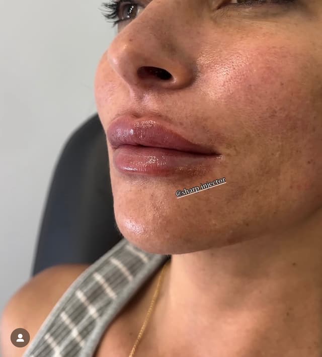Side profile of lip filler results for a balanced projection in Huntington Beach, CA.