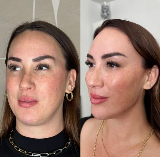 Chin, jawline, and cheek filler before and after