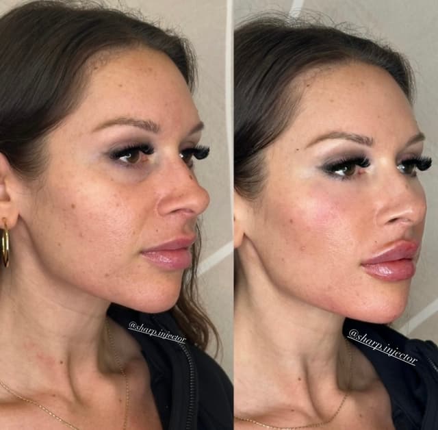 side profile jawline and chin filler before and after